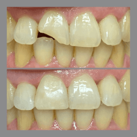 before and after chipped tooth