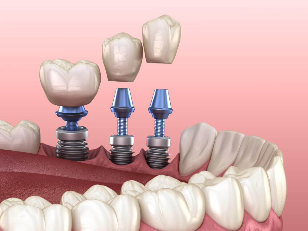 Illustration of dental implants