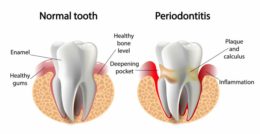 Illustration of periodontis