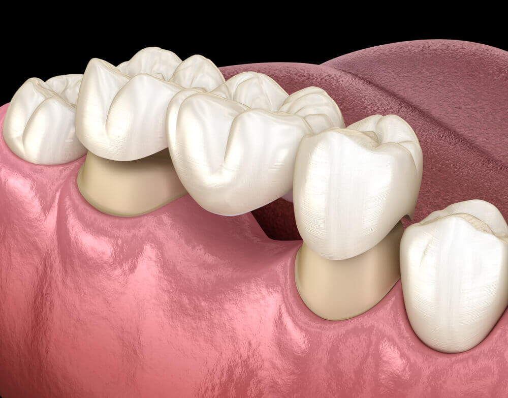 Illustration of dental restoration bridge