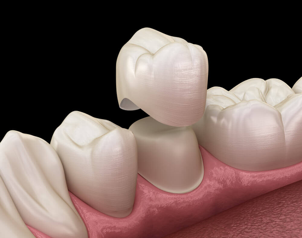 Illustration of dental crown