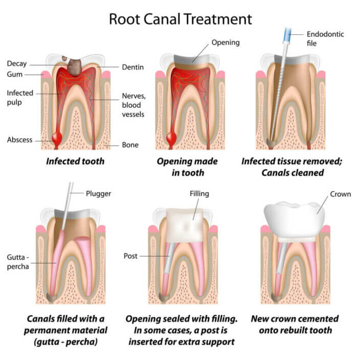 Root canal diagram