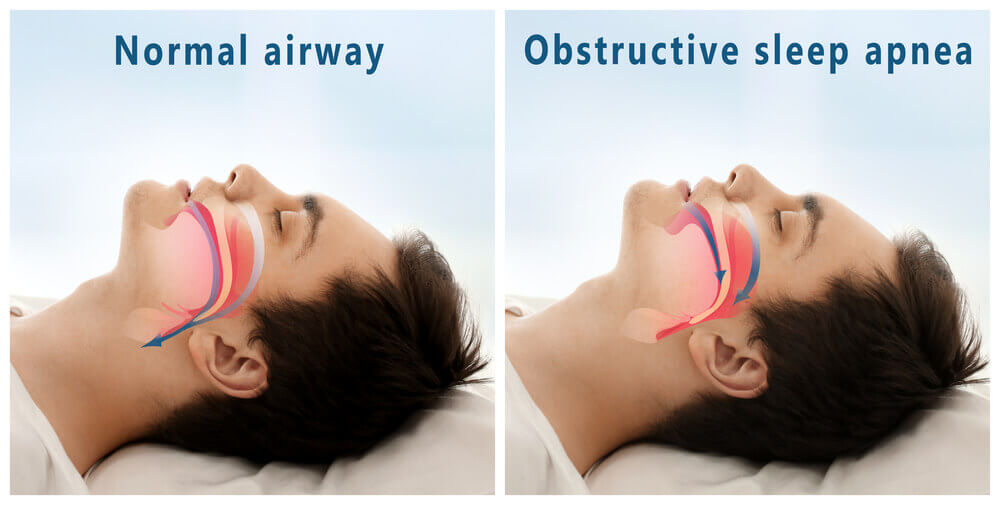 Sleep apnea illustration